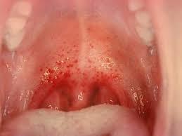 Мокрота в горле без кашля: причины, симптомы и возможное лечение