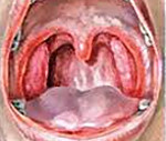 Симптомы ангины у взрослого без температуры: лечим катаральную ангину