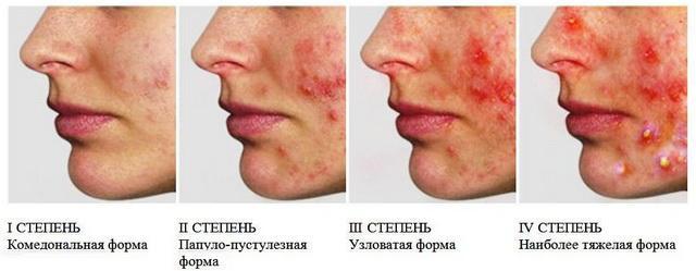 Прыщи на лице: причины появления воспалений, методы борьбы с высыпаниями