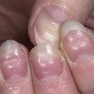 Продольные полосы на ногтях рук: причины, признаки, лечение и профилактика