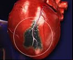 Причины инфаркта: всё о развитии опасного сердечного заболевания