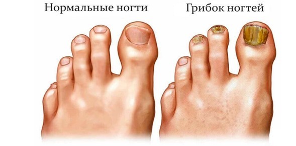 Народное средство от грибка ногтей на ногах: самые эффективные рецепты