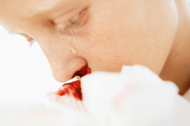 Почему идёт кровь из носа у подростка: причины явления, способы лечения
