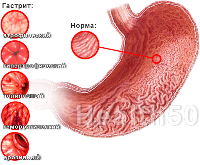 Симптомы гастрита желудка у взрослых: причины возникновения
