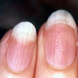 Продольные полосы на ногтях рук: причины, признаки, лечение и профилактика