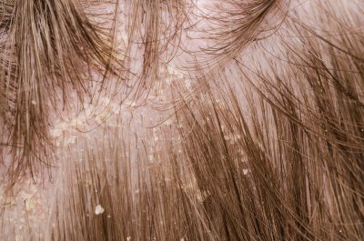 Перхоть и выпадение волос: причины проблем и их решение