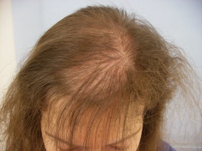 Перхоть и выпадение волос: причины проблем и их решение