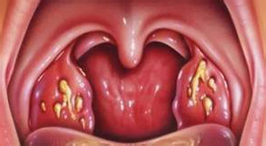 Симптомы ангины у взрослого без температуры: лечим катаральную ангину