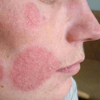 Себорея на лице: виды заболевания, причины, лечение и профилактика