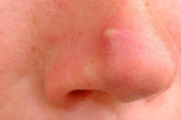 Простуда на лице: причины появления, способы борьбы с высыпаниями