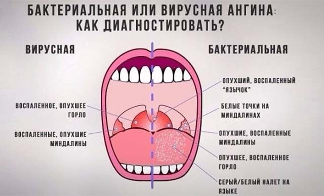 Профилактика ангины: предотвращаем боль в горле и отёк миндалин