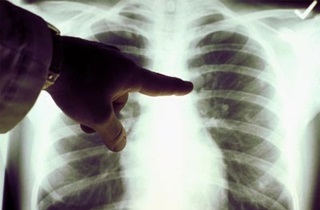 Удушающий кашель: причины проблемы, эффективные народные средства