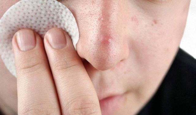 Прыщи на носу: причины у женщин, у мужчин, методы лечения