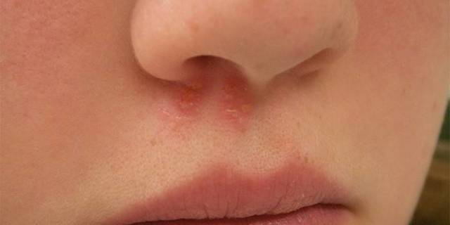 Простуда в носу: чем лечить инфекцию в домашних условиях
