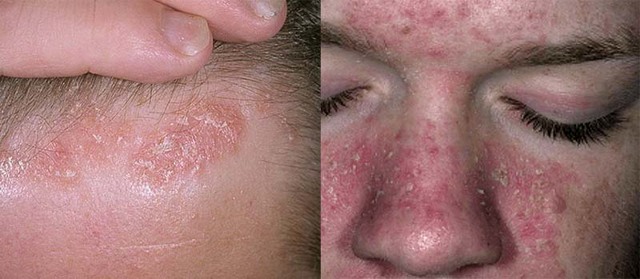 Себорея на лице: виды заболевания, причины, лечение и профилактика