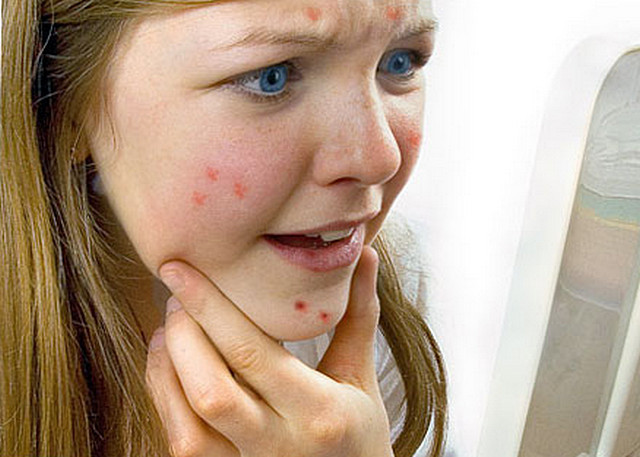 Прыщи на лице: причины появления воспалений, методы борьбы с высыпаниями