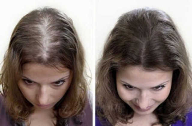 Почему выпадают волосы на голове у женщин: что делать в этом случае