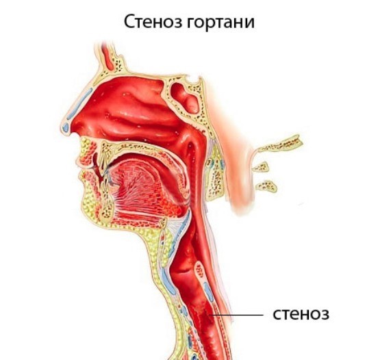 Профилактика ангины: предотвращаем боль в горле и отёк миндалин