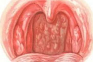 Першение в горле и сухой кашель длительное время: причины явления