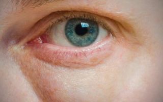 Отекают верхние веки глаз: причины, симптомы, диагностика и лечение